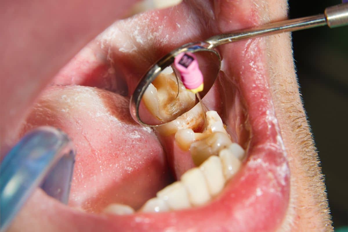 Dental Fillings in Dublin