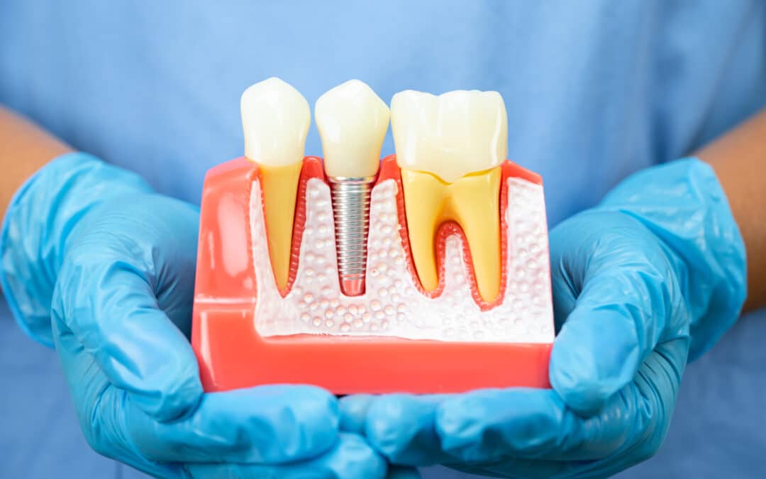 Can Dental Implants Cause Gum Pain After Healing?